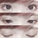 二重埋没 湘南美容クリニック 長野院 DAY 16 サムネイル用