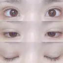 二重埋没 湘南美容クリニック 長野院 DAY 16 サムネイル用