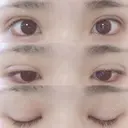 二重埋没 湘南美容クリニック 長野院 DAY 17 サムネイル用