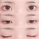 二重埋没 湘南美容クリニック 長野院 DAY 32 サムネイル用