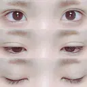 二重埋没 湘南美容クリニック 長野院 AFTER サムネイル用