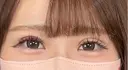 二重埋没 / 上まぶたの脂肪取り アリエル美容クリニック 大宮院 DAY 9 サムネイル用