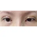 二重切開 / 目頭切開 / 上まぶたの脂肪取り / 蒙古ひだ形成 FROM B整形外科 (旧バウム整形外科) DAY 7 サムネイル用
