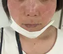 シワ取りボトックス / 肌育注射（ジュベルックなど） / ピコレーザートーニング（美白・肝斑） / ピコスポット 東京シルククリニック 新宿院 DAY 0 サムネイル用