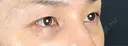 クマ治療 藤・ナチュレ美容クリニック 銀座院 DAY 10 サムネイル用