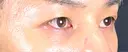 クマ治療 藤・ナチュレ美容クリニック 銀座院 DAY 30 サムネイル用
