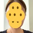 糸リフト / 骨削り（頬） View美容整形外科 DAY 7 サムネイル用