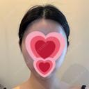 ヒアルロン酸注入（頬） / ヒアルロン酸注入（こめかみ） フィラークリニック 錦糸町院 AFTER サムネイル用