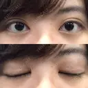 二重切開 / 目頭切開 / ほくろ・いぼ切除（肌） / 上まぶたたるみ取り / 上まぶたの脂肪取り 東京美容外科 銀座院 DAY 82 サムネイル用