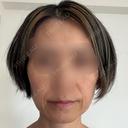 RF（高周波）たるみ治療 ルラ美容クリニック 札幌大通り院 AFTER サムネイル用