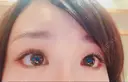 目尻切開 / タレ目形成・グラマラスライン（切開） シエルクリニック DAY 15 サムネイル用