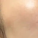 ルメッカ ゼノクリニック AFTER サムネイル用