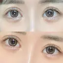 ヒアルロン酸注入（涙袋） HAAB×DREAM BEAUTY CLINIC 東京本院 DAY 9 サムネイル用