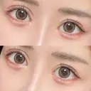 ヒアルロン酸注入（涙袋） HAAB×DREAM BEAUTY CLINIC 東京本院 DAY 10 サムネイル用