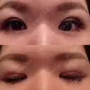 二重埋没 メディカルビューティセンター DAY 6 サムネイル用