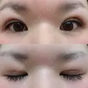 二重埋没 メディカルビューティセンター DAY 7 サムネイル用