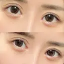 ヒアルロン酸注入（涙袋） HAAB×DREAM BEAUTY CLINIC 東京本院 DAY 29 サムネイル用