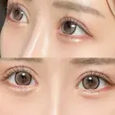 ヒアルロン酸注入（涙袋） HAAB×DREAM BEAUTY CLINIC 東京本院 AFTER サムネイル用