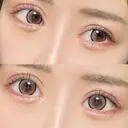 ヒアルロン酸注入（涙袋） HAAB×DREAM BEAUTY CLINIC 東京本院 DAY 30 サムネイル用