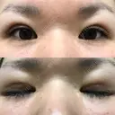 二重埋没 メディカルビューティセンター DAY 8 サムネイル用