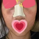 隆鼻術 / 鼻尖形成（切開） / 軟骨移植 / 骨切幅寄せ / ワシ鼻修正・ハンプ切除 / 斜鼻修正 / 鼻修正 韓国BBクリニック（旧 シンミアン形成外科） DAY 2 サムネイル用