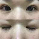 二重埋没 メディカルビューティセンター DAY 9 サムネイル用