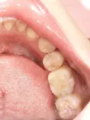 セラミック 東京美容外科 赤坂院 AFTER サムネイル用