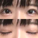 二重切開 / 目元修正 ルネッサンス美容外科医院 神戸院 AFTER サムネイル用