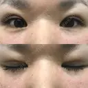 二重埋没 メディカルビューティセンター DAY 11 サムネイル用