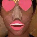 隆鼻術 / 鼻尖形成（切開） / 軟骨移植 / 骨切幅寄せ / ワシ鼻修正・ハンプ切除 / 斜鼻修正 / 鼻修正 韓国BBクリニック（旧 シンミアン形成外科） DAY 5 サムネイル用