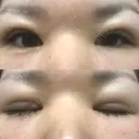 二重埋没 メディカルビューティセンター DAY 13 サムネイル用