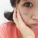 下まぶたの脂肪取り 表参道スキンクリニック 表参道院 DAY 2 サムネイル用