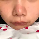 鼻尖形成（切開） / 小鼻縮小（切開） / 軟骨移植 / 眉間プロテーゼ 湘南美容クリニック 熊本院 AFTER サムネイル用