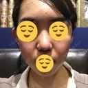 鼻尖形成（切開） / 鼻中隔延長（切開） / 小鼻縮小（切開） / 軟骨移植 / 骨切幅寄せ HANABI整形外科 DAY 128 サムネイル用