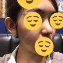 鼻尖形成（切開） / 鼻中隔延長（切開） / 小鼻縮小（切開） / 軟骨移植 / 骨切幅寄せ HANABI整形外科 DAY 128 サムネイル用