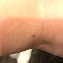 ボトックス（ふくらはぎ） REYOUNGクリニック DAY 3 サムネイル用