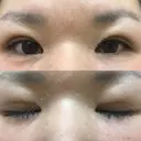 二重埋没 メディカルビューティセンター DAY 14 サムネイル用