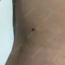 ボトックス（ふくらはぎ） REYOUNGクリニック DAY 4 サムネイル用