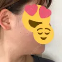 脂肪溶解注射（顔） 聖心美容クリニック 広島院 DAY 19 サムネイル用