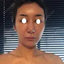 鼻尖形成（切開） / 糸リフト / 目尻切開 / こめかみ形成 / 肌ヒアルロン酸注入（たるみ・シワ改善） / ヒアルロン酸注入（あご） / ヒアルロン酸注入（唇） あきこクリニック DAY 13 サムネイル用