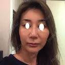 鼻尖形成（切開） / 糸リフト / 目尻切開 / こめかみ形成 / 肌ヒアルロン酸注入（たるみ・シワ改善） / ヒアルロン酸注入（あご） / ヒアルロン酸注入（唇） あきこクリニック DAY 14 サムネイル用