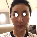 鼻尖形成（切開） / 糸リフト / 目尻切開 / こめかみ形成 / 肌ヒアルロン酸注入（たるみ・シワ改善） / ヒアルロン酸注入（あご） / ヒアルロン酸注入（唇） あきこクリニック DAY 15 サムネイル用