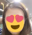 バッカルファット除去 / 脂肪吸引（顔） / ヒアルロン酸注入（あご） / ボトックス（エラ・小顔） エートップ美容整形外科 DAY 7 サムネイル用