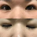 二重埋没 メディカルビューティセンター DAY 18 サムネイル用