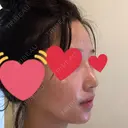 隆鼻術 / 鼻尖形成（切開） / 軟骨移植 / 骨切幅寄せ / ワシ鼻修正・ハンプ切除 / 斜鼻修正 / 鼻修正 韓国BBクリニック（旧 シンミアン形成外科） DAY 12 サムネイル用