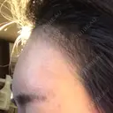 額を丸く / ヒアルロン酸注入（額） エートップ美容整形外科 DAY 14 サムネイル用