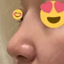 隆鼻術 / 鼻尖形成（切開） / 軟骨移植 / 骨切幅寄せ / ワシ鼻修正・ハンプ切除 / 斜鼻修正 / 鼻修正 韓国BBクリニック（旧 シンミアン形成外科） AFTER サムネイル用