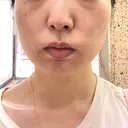 脂肪溶解注射（顔） ビクアスクリニック DAY 19 サムネイル用