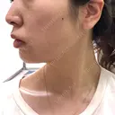 脂肪溶解注射（顔） ビクアスクリニック DAY 19 サムネイル用