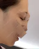 鼻尖形成（切開） / 鼻中隔延長（切開） / 軟骨移植 / 骨切幅寄せ / ワシ鼻修正・ハンプ切除 / 眉間プロテーゼ グロービー美容整形外科 DAY 0 サムネイル用